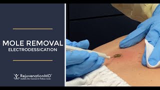 Electrodessication to Remove Seborrheic Keratosis [upl. by Hoseia]