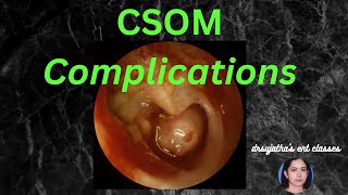 037 Complications of Suppurative Otitis Media csom [upl. by Ahsien]