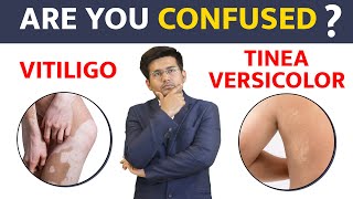 Is it Vitiligo or Tinea Versicolor  Bharat Homeopathy [upl. by Iaverne569]