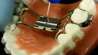 Bracesquestionscom  Orthodontic Jaw Expander How to Turn [upl. by Ykcub]