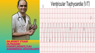 VENTRICULAR TACHYCARDIA BY DRSUMIT TYAGISUMITMEDICALDISPENSARY1 [upl. by Nomra80]