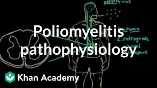 Poliomyelitis pathophysiology  Infectious diseases  NCLEXRN  Khan Academy [upl. by Glaser986]