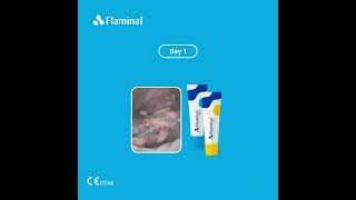 Case report  treatment of a Pressure Ulcer with Flaminal® [upl. by Vierno]