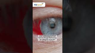 Identify patient’s condition presenting with orbital ecchymosis amp subconjunctival hemorrhage [upl. by Latoye]