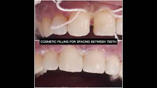 TOOTH COLOR COMPOSITE FILLING TO CLOSE GAP BETWEEN FRONT TEETH [upl. by Naima]