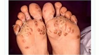 Keratoderma blennorrhagica in hindi  Tarang academy dermatology [upl. by Allecsirp]