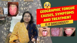 Is it dangerous Geographic tongue causes symptoms and treatment [upl. by Aicelaf923]