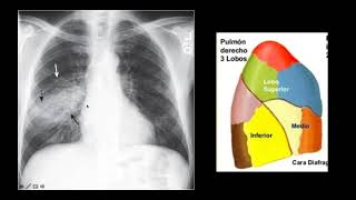 CLASE 7 PATRON CONSOLIDATIVO PULMONAR [upl. by Colleen519]