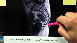 Vitamin E marker for MRI in Tailbone Pain Coccyx Pain [upl. by Chelsey]