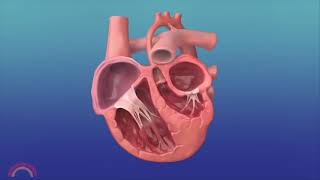 InUtero Procedure to Reverse Hypoplastic Left Heart Syndrome [upl. by Cornwall]