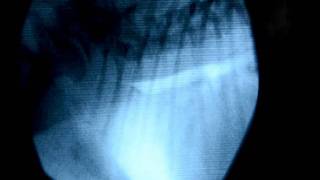 Colapso traqueal fluoroscopia y endoscopia [upl. by Noived564]