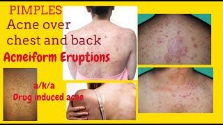 Pimples on chest and back or Acneiform Eruptions aka Drug induced acne  with Teratogenic Drugs [upl. by Ahsemrac]