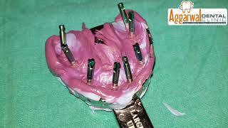 Full Mouth impressions of Osstem Dental Implants [upl. by Low]