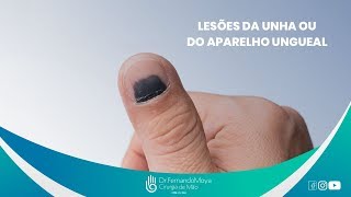 Lesões da unha o que são e tratamentos  Dr Fernando Moya CRM 112046 [upl. by Enahpad]