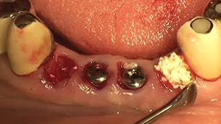 Socket preservation using alloplastic graft material OSTEON™ [upl. by Berry]