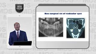 4 5 Radicular Cyst Treatment [upl. by Chic]