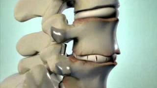 Degenerative Disc Disease  DePuy Videos [upl. by Hashimoto]