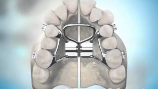 Surgically Assisted Palatal Expansion [upl. by Lowenstern]