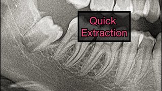 Mesioangular Third Molar Extraction [upl. by Asiuol882]