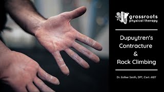 Dupuytrens Contracture and Rock Climbing [upl. by Leizahaj]