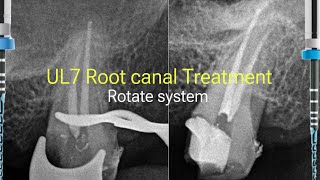 UL7 root canal treatment 2 canals [upl. by Carri]