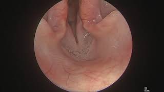 Laryngeal paralysis in a dog [upl. by Amo]