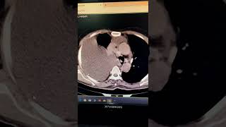 Massive plural effusion before and after thoracentesis [upl. by Jilli]