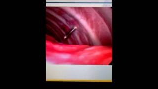 Blind pleural biopsy [upl. by Palermo]