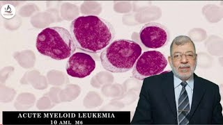 Acute Myeloid Leukemia 10 M6 [upl. by Borreri]