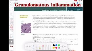 Granulomatous Inflammation Pathology 33  First Aid USMLE Step 1 in UrduHindi [upl. by Mientao]