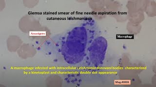 Leishmania donovani amastigote in Cutaneous leishmaniasis Patient [upl. by Esinehs]