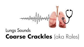 Coarse Crackles Rales  Lung Sounds  Medzcool [upl. by Annaiviv]