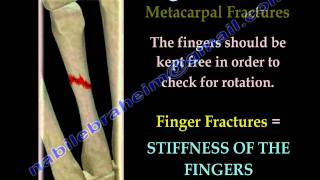 Finger and metacarpal Fractures  Everything You Need To Know  Dr Nabil Ebraheim [upl. by Enyamrahc]