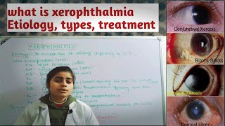 what is XEROPHTHALMIA आँखों का सूखा रोग  Etiology types treatment   Optometry solution [upl. by Yrrek848]