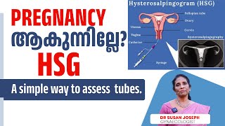 Blocked tubes HSG an easy way to analyse the tubal factor  DRSUSAN JOSEPH [upl. by Marilou]