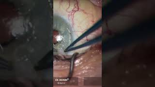 Fixing corneal scars from pterygium surgery with superficial keratectomy cornea cornealscars [upl. by Nerty]