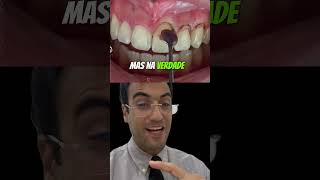 DENTES CURTOS drmiltonresponde [upl. by Olumor]