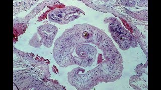 Schistosomiasis  Pathology mini tutorial [upl. by Adelia]