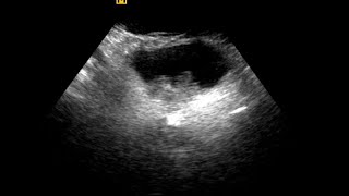 Urinary Bladder Mass  Differential Diagnosis [upl. by Fuld]