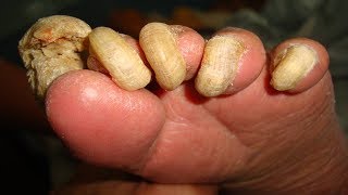 Home Remedies For Toenail Fungus That Work – CRUSH Nail Fungus Naturally [upl. by Nagaet]