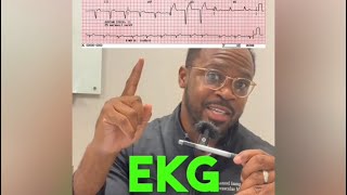 Heart Doctor Explains Left Bundle Branch Block [upl. by Olivero]