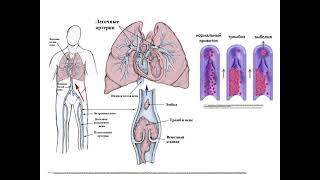 Thrombosis EmbolismViolations microcirculation [upl. by Stockmon632]