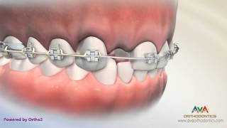 Orthodontic amp Restorative Treatment for Missing Lateral Incisor  Different Options [upl. by Kali]