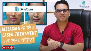 Best Treatment for Melasma  Laser Treatment for Melasma in Delhi  SkinQure  Dr Jangid [upl. by Nevi]