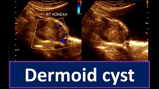 Understanding Dermoid Cyst  Guide to Ultrasonogram Diagnosis Ovarian Cyst  Practical Ultrasonogram [upl. by Lubeck]