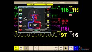 Hemodynamic monitoring in cardiogenic shock DrPuneet Goyal [upl. by Nalrah246]