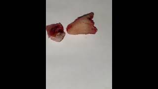 Wisdom extraction umairtoothfairy dentalsmile umairazeem viral shorts Umairazeem8553 [upl. by Ttayw]