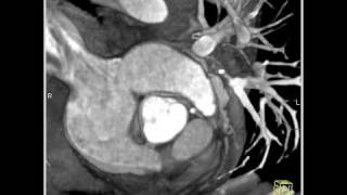 Cardiac Circumflex arises off RCA right coronary artery 3 of 3 [upl. by Noorah]