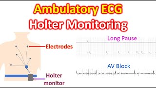 Ambulatory ECG Holter Monitoring [upl. by Ttirrem860]