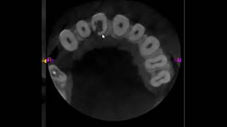 Management of Internalexternal resorption in a maxillary incisor [upl. by Gorlin640]